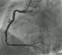 veins inside the heart